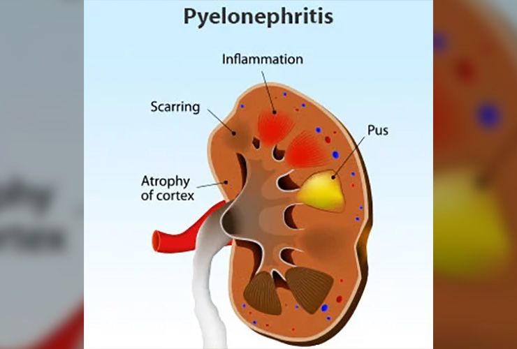 Signs Your Back Pain Could Be A Kidney Infection LifeDaily