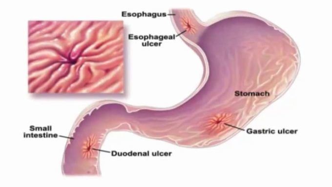 various-treatments-for-people-with-peptic-stomach-ulcers-lifedaily