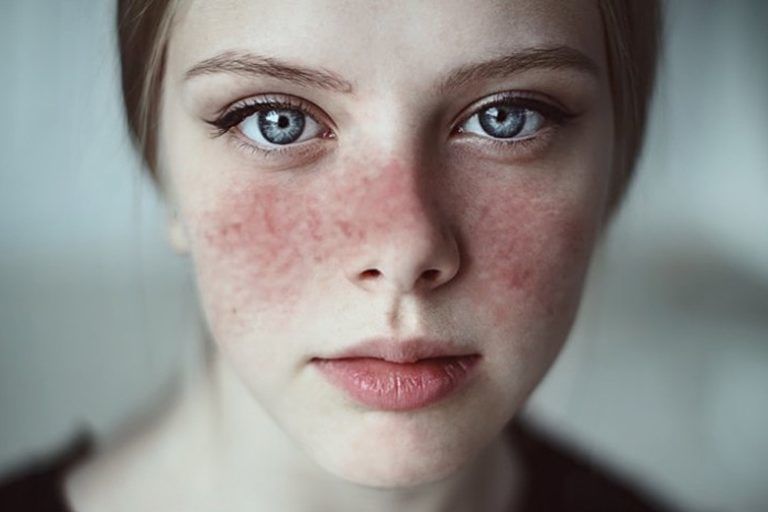20 Signs And Symptoms That You May Have Lupus LifeDaily