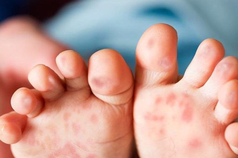 hand-foot-mouth-disease-safety-steps