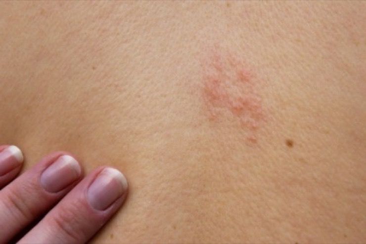 Shingles During Pregnancy Treatment Pregnancywalls