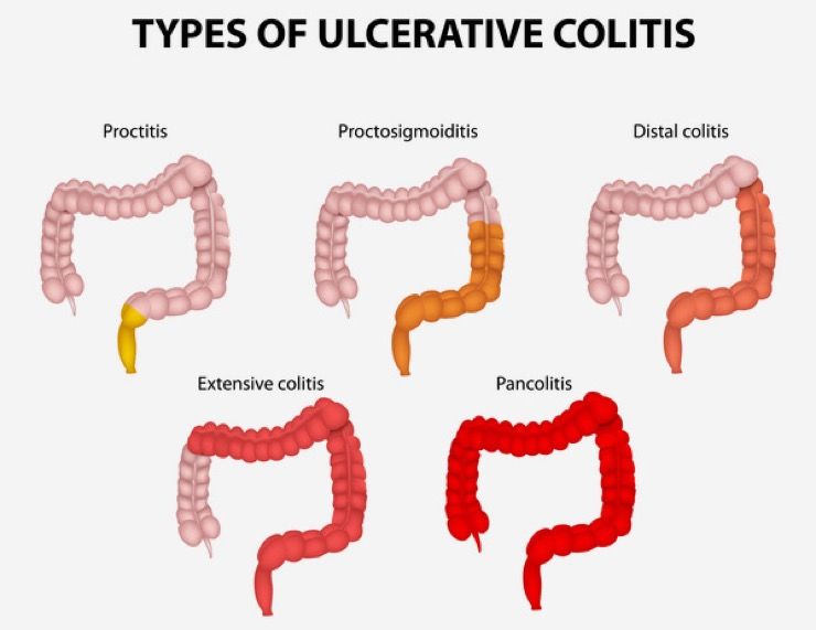 blood in stool upper gi tract