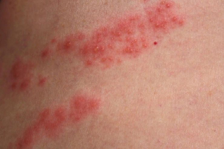 How Stress Can Cause Shingles And What You Can Do To Help 