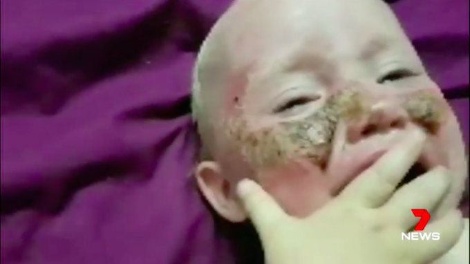 Kondisi wajah bayi setelah memakai tabir surya. 7 News
