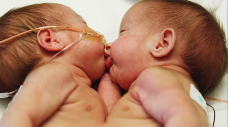 Given No Chance To Live, Conjoined Twins Defy The Odds On Their 2nd Birthda...
