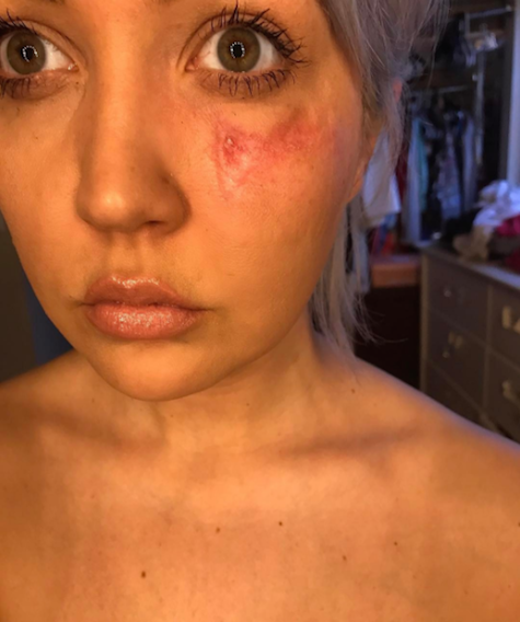 Kondisi wajah Meghan Linsey