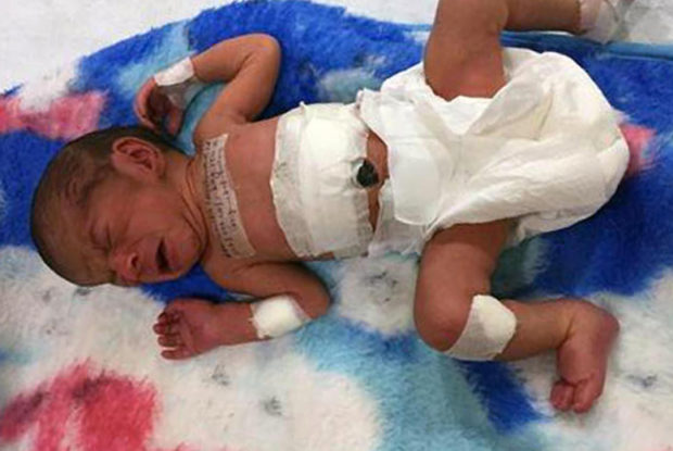 Baby Miraculously Survives After Doctors Realize What Her ‘Twin’ Did To ...