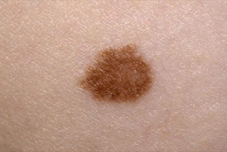 Common Types of Cancer Story