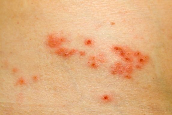 Early Signs You May Have Shingles, Learn The Symptoms and Treatment ...