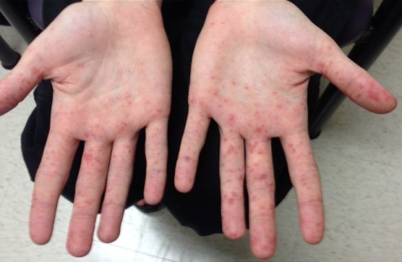 Signs of Hand-Foot-and-Mouth Disease (HFMD) You Shouldn’t Ignore ...